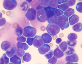 Bone marrow smear of T-cell acute lymphoblastic leukemia