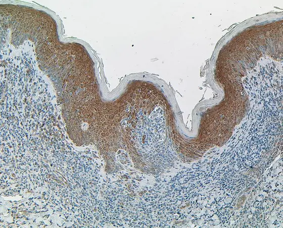 Gewebe-Dünnschnitt eines kutanen T-Zell-Lymphoms. Die Zellkerne sind blau gefärbt, PP4R1 braun. Die unter der Haut liegenden T-Zellen weisen keine braune Färbung und somit kein PP4R1 auf.