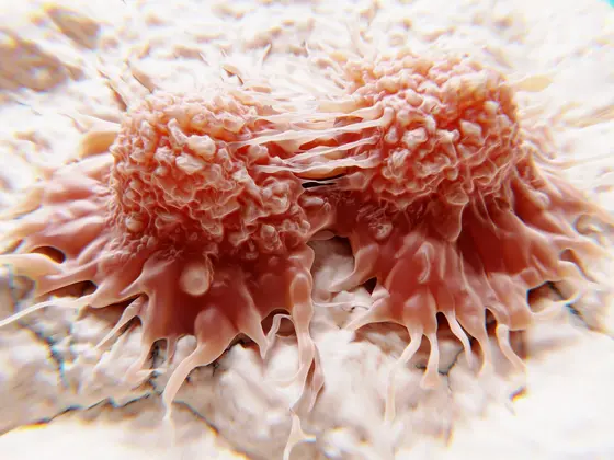 Nahaufnahme von zwei Krebszellen, die sich stark vergrößert und detailreich präsentieren. Die Zellen haben unregelmäßige, ausladende Formen mit einer rauen Oberfläche und sind auf einem hellen, verschwommenen Hintergrund dargestellt. Diese Abbildung veranschaulicht das Aussehen von Tumorzellen im Mikroskop.