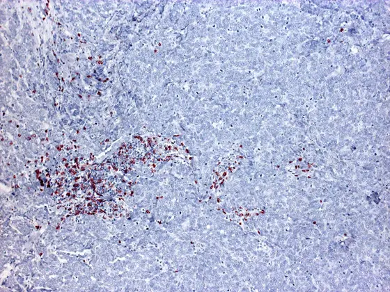 Gewebeschnitt durch ein Merkelzellkarzinom. Die T-Zellen der Immunabwehr (rot) erkennen die Tumorzellen (hellblau) nicht und dringen deshalb nicht in das Innere des Tumors ein.