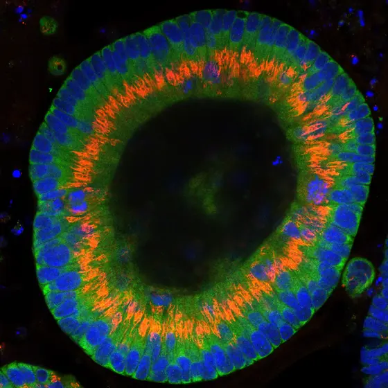 Colon cancer cells growing into a 3-dimensional organoid cell culture in a culture dish.
