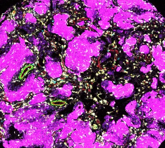 Mikroskopische Ansicht einer Probe, die vorwiegend in lebhaften Lila- und violetten Farbtönen dargestellt ist. Die Struktur zeigt verschiedene organische Formen und Texturen, die auf zelluläre oder gewebliche Elemente hinweisen. Es gibt auch Stellen in Grün und anderen Farben, die zusätzliche Details bieten.