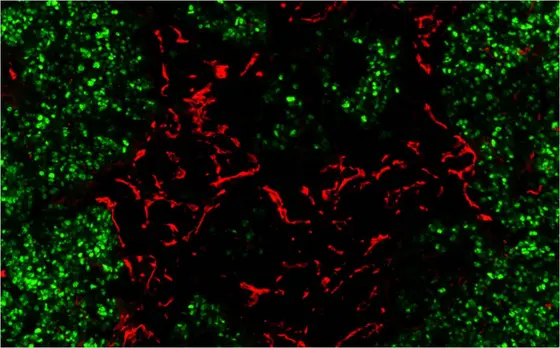 Ein großes Problem für die Immuntherapie bei Krebs: Fehlerhaft ausgebildete Blutgefäße (rot). Grün: Tumorzellen