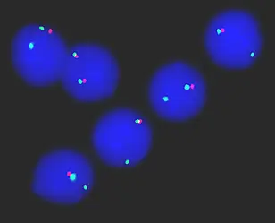 Leukämiezellen, in deren Zellkern sich lediglich ein rotes Signal findet, haben einen Teil des Chromosoms 17 verloren. Das führt zu Resistenz gegen Chemotherapie und Zelltod. Quelle: Daniel Mertens, Universität Ulm und Deutsches Krebsforschungszentrum