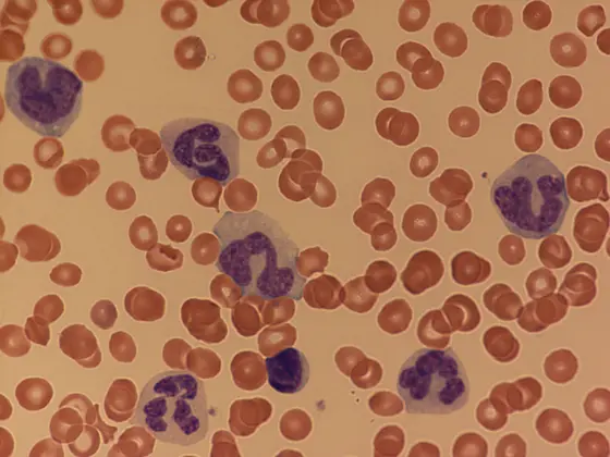 The peripheral blood of JMML patients contains far too many immature myeloid and monocytic cells.