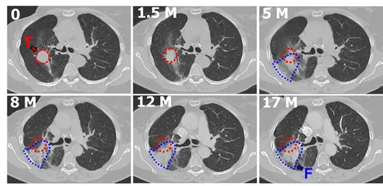 Nach Bestrahlung eines bösartigen Tumors in der Lunge (rot) entwickelt der Patient im Verlauf von 17 Monaten eine Lungenfibrose (blau).