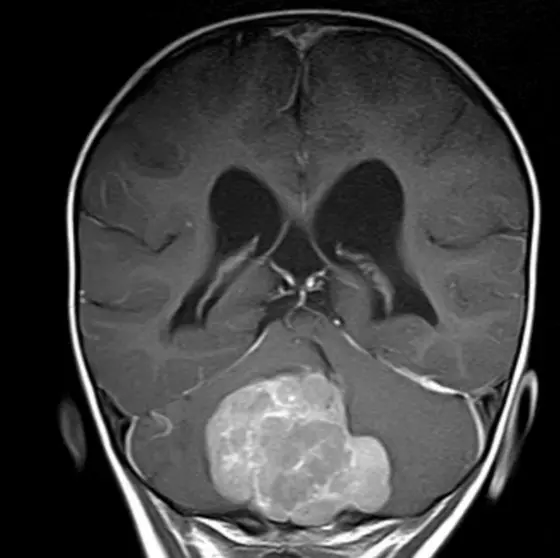 An MRI scan displays a cross-sectional view of the brain. A mass is visible in the lower frontal region, suggesting a possible tumor or abnormal growth. Surrounding brain structures appear normal, with clear outlines of the nasal passages and sinuses.