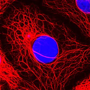 Fluorescence micrograph of breast cancer cells