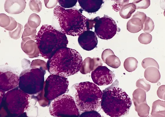 Bei Patienten, die an einer AML erkrankt sind, enthält das Knochenmark viel zu viele unreife myeloische Zellen.