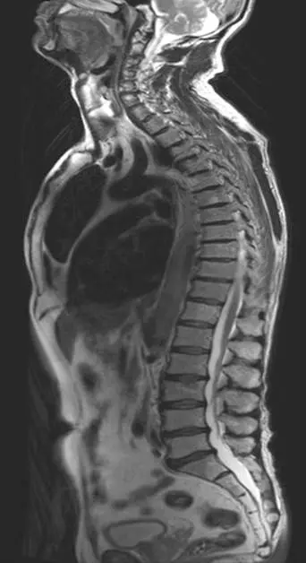 Das MRT liefert bessere Weichteilkontraste und mehr Informationen über den Tumor