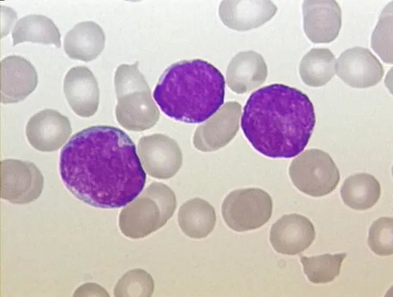 Akute lymphoblatische Leukämie, Blutausstrich