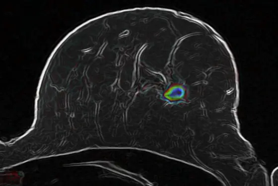 Optimized diffusion-weighted MR imaging (MRI) of a suspicious lesion in a female breast