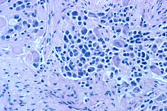 Mikroskopische Ansicht eines Neuroblastoms