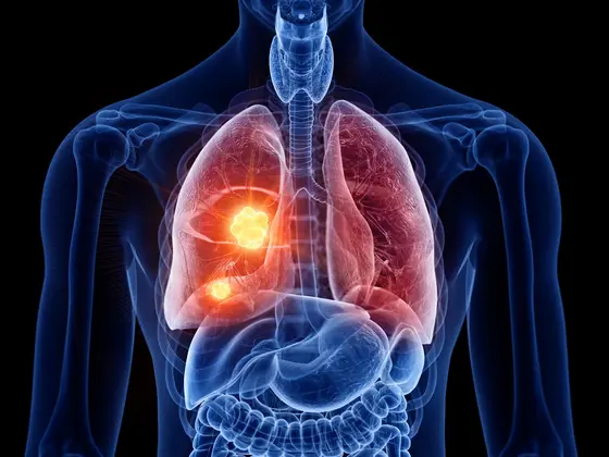 Eine anatomische Darstellung eines menschlichen Körpers mit hervorgehobenen Lungen. Eine Lunge zeigt farbige Bereiche, die möglicherweise auf eine Erkrankung oder Anomalie hinweisen. Der Fokus liegt auf der funktionalen Struktur der Lungen und deren Bedeutung für die Atmung.