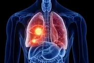 Eine anatomische Darstellung eines menschlichen Körpers mit hervorgehobenen Lungen. Eine Lunge zeigt farbige Bereiche, die möglicherweise auf eine Erkrankung oder Anomalie hinweisen. Der Fokus liegt auf der funktionalen Struktur der Lungen und deren Bedeutung für die Atmung.