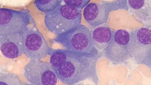 Krankhaft veränderte Plasmazellen (Myelomzellen, lila gefärbt) im Knochenmark.