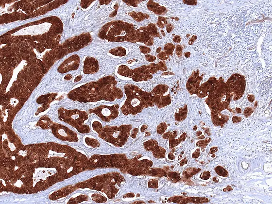 Braun gefärbtes Dickdarmkarzinom, bei dem sich einzelne Tumorzellen und –zellverbände vom Tumor lösen und in das hell gefärbte normale Gewebe einwandern.