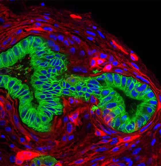 Pankreaskarzinom (grün) in einer Mauslinie mit mutiertem Kras-Gen. In rot sind Zellen des Tumormikromilieus (Fibroblasten, Immunzellen, Endothelzellen) zu sehen.