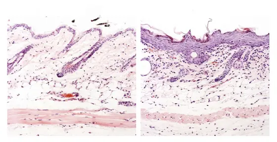 Gewebeschnitte: Maus mit gesunder Haut (links) und mit Psoriasis-ähnlichem Krankheitsbild (rechts).