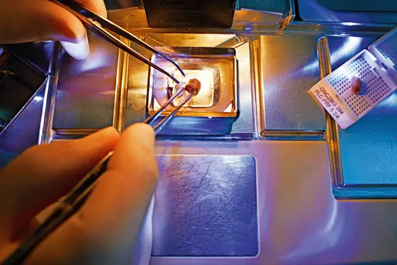 Tumorprobe, in Paraffin eingebettet