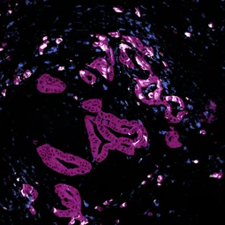 Das Bild zeigt einen mikroskopischen Ausschnitt von Gewebe mit leuchtend magentafarbenen Strukturen auf einem dunklen Hintergrund. Die Formen sind unregelmäßig und scheinen unterschiedlich angeordnet zu sein, was auf biologische Gewebeproben hindeutet.