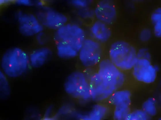 Unterschiedliche Anzahl der PD-L1-Genkopien (grün) in den Chromosomen (blau) von Blasentumorzellen (Fluoreszenz in-situ Hybridisierung)