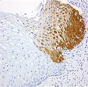Gewebeschnitt vom Gebärmutterhals: Die braune Färbung ist ein Indiz für bösartig veränderte Zellen. Quelle: mtm laboratories