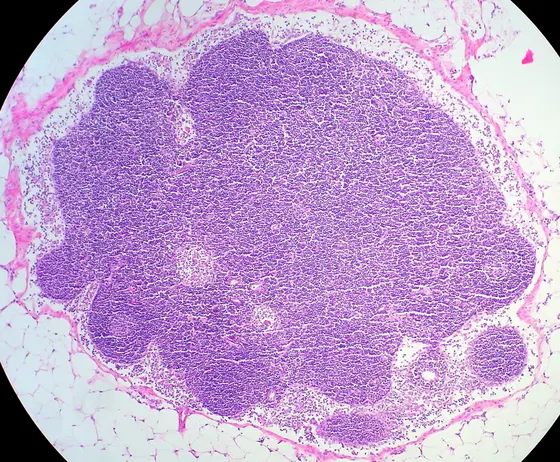 Mikroskopische Aufnahme eines Gewebes mit einer großen, lila gefärbten Zellansammlung, umgeben von helleren, fettigen Bereichen. Die Struktur zeigt eine dichte, homogene Massenanordnung, die auf histologische Merkmale hinweist.