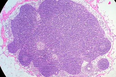 Mikroskopische Aufnahme eines Gewebes mit einer großen, lila gefärbten Zellansammlung, umgeben von helleren, fettigen Bereichen. Die Struktur zeigt eine dichte, homogene Massenanordnung, die auf histologische Merkmale hinweist.