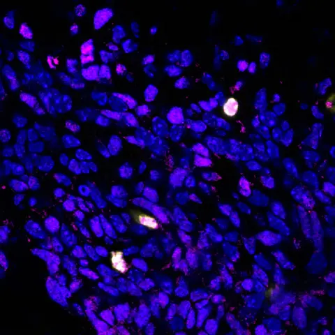 Das Bild zeigt die Produktion des Proteins BCOR (pink) in den Hirnzellen von Mäusen, bei denen das Gen Ptch1 mutiert ist. Besonders viel BCOR wird in Zellen produziert, die sich aktiv teilen (gelb).