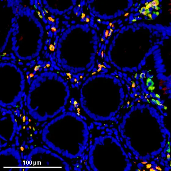 CD68-positive Entzündungszellen (rot) in tumornahem Gewebe eines Darmkrebspatienten exprimieren das BMMF-Rep-Protein (grün)