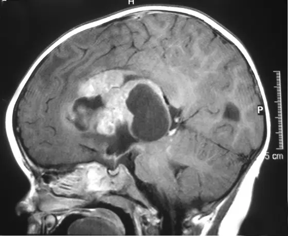 Magnetresonanztomographie eines großen atypischen teratoiden/rhabdoiden Tumors bei einem Säugling
