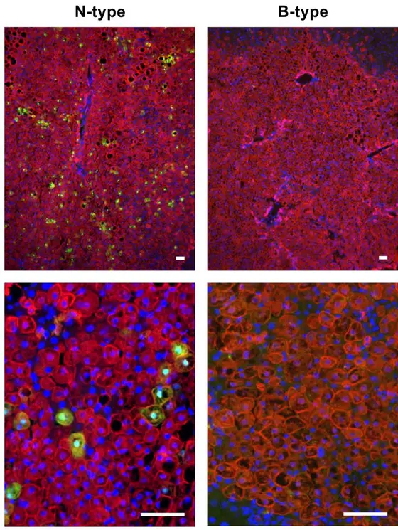 HBV (green) in liver cells (red): Only virions of the N-Type (left) are tranferred into the liver and are able to infect liver cells, HBV of the B-type (right) are not.