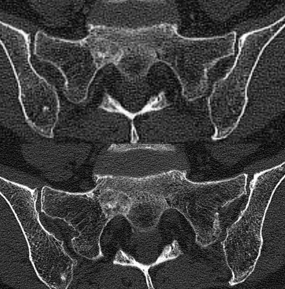 Aufnahme des Beckens einer Brustkrebspatientin mit Knochenmetastasen. Oben: Konventionelle CT-Aufnahme, unten: Photon-Counting CT