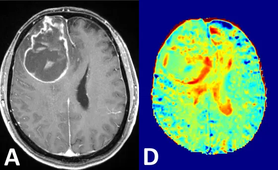 Visualization of brain cancer by conventional contrast agents (left) and by the novel glucose MRI method (right).