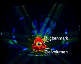 Darstellung der kritischen Dosisverteilung eines um das Rückenmark herumwachsenden Tumors