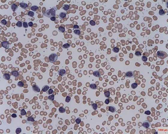Zellen der Chronisch lymphatischen Leukämie (CLL)