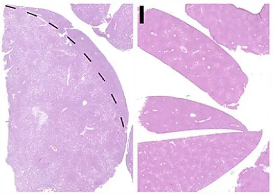 Leberkrebs (links) und gesunde Leber (rechts)