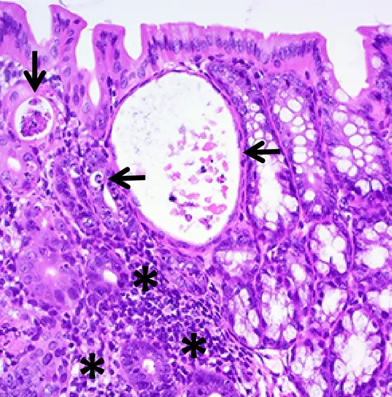 Gewebeschnitt Dickdarm einer Maus mit chronischer Kolitis, die der chronische Entzündung beim Menschen sehr ähnlich ist. Pfeile zeigen den Zelltod (Nekrose oder Apoptose). Sterne markieren die Entzündungsherde.