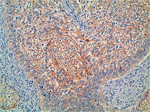 Non-small cell lung cancer