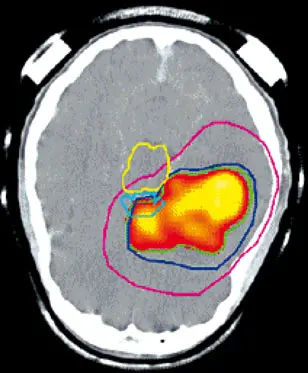 Darstellung eines Hirntumors mit Computer- und Positronenemissions-Tomographie. Die farbigen Konturen dienen zur Planung einer Strahlentherapie
