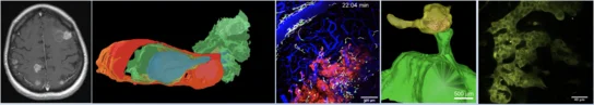 Examples of brain metastases research