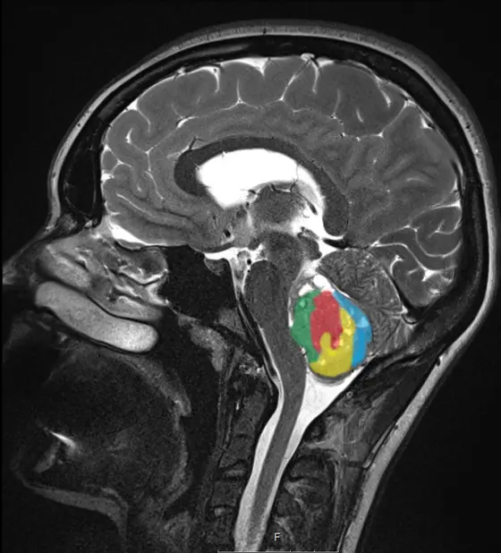 Medulloblastome (gelber Kreis) gehören bei Kleinkindern zu den häufigsten bösartigen Hirntumoren.
