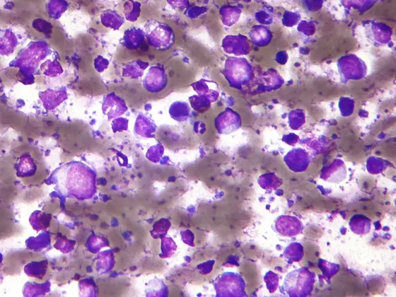 B-Zell-Lymphom