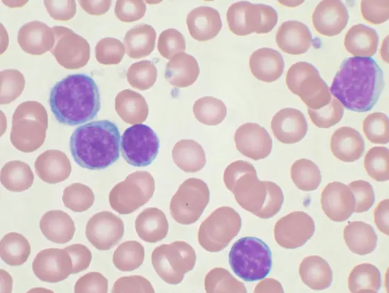 Peripheral blood smear showing chronic lymphocytic leukemia (CLL)