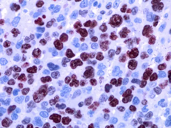 Die Knochenmarkhistologie eines refraktären Myeloms. Die Myelomzellen sind dicht gepackt und vermehren sich sehr schnell (rot eingefärbt).