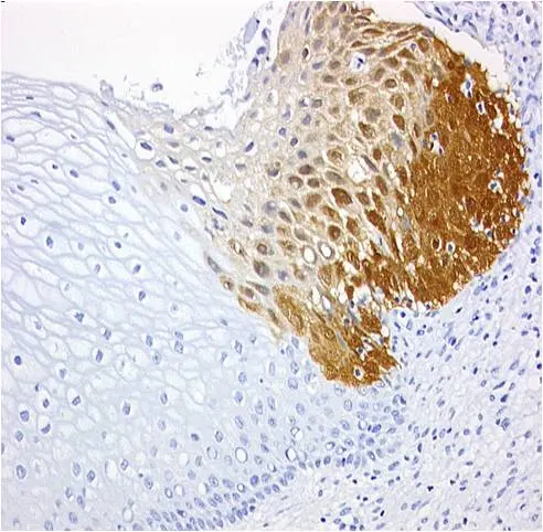 Gewebeschnitt vom Gebärmutterhals: Die braune Färbung ist ein Indiz für bösartig veränderte Zellen.