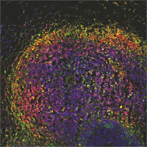 Immunofluorescence of a cutaneous T cell lymphoma after treatment with DMF (human lymphoma cells were transplanted into the skin of mice). Malignant cells are stained red, dying cells are stained green. In dying tumor cells, the colors superimpose and appear yellow. The huge number of yellow cells indicates that DMF efficiently kills tumor cells.