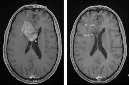 Medulloblastomrezidiv vor und nach Therapie