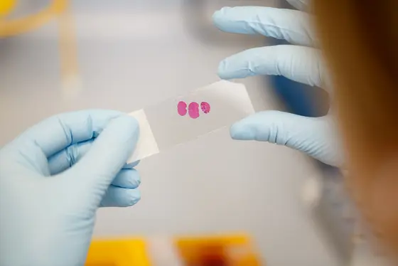 Molecular analyses can deliver valuable additional information about the exact type and biological behavior of tumors.